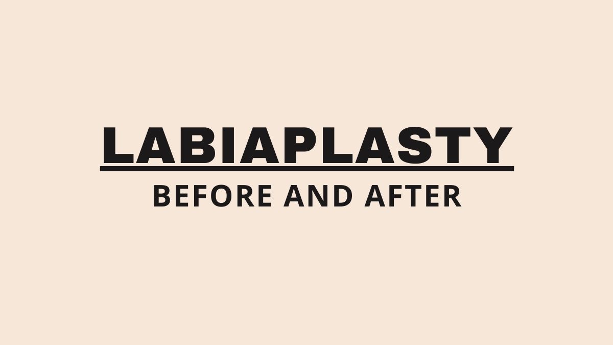 Labiaplasty Before and After