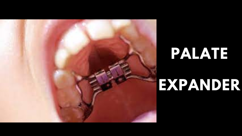 palate expander